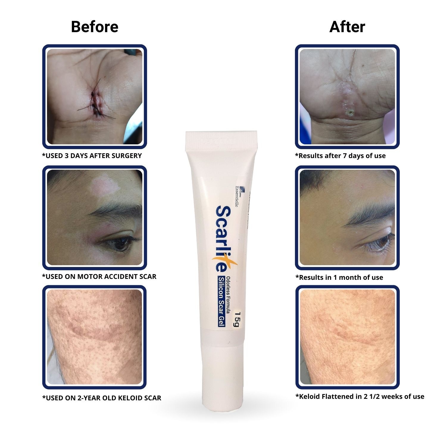 SCARLITE Silicon scar gel 15 grams