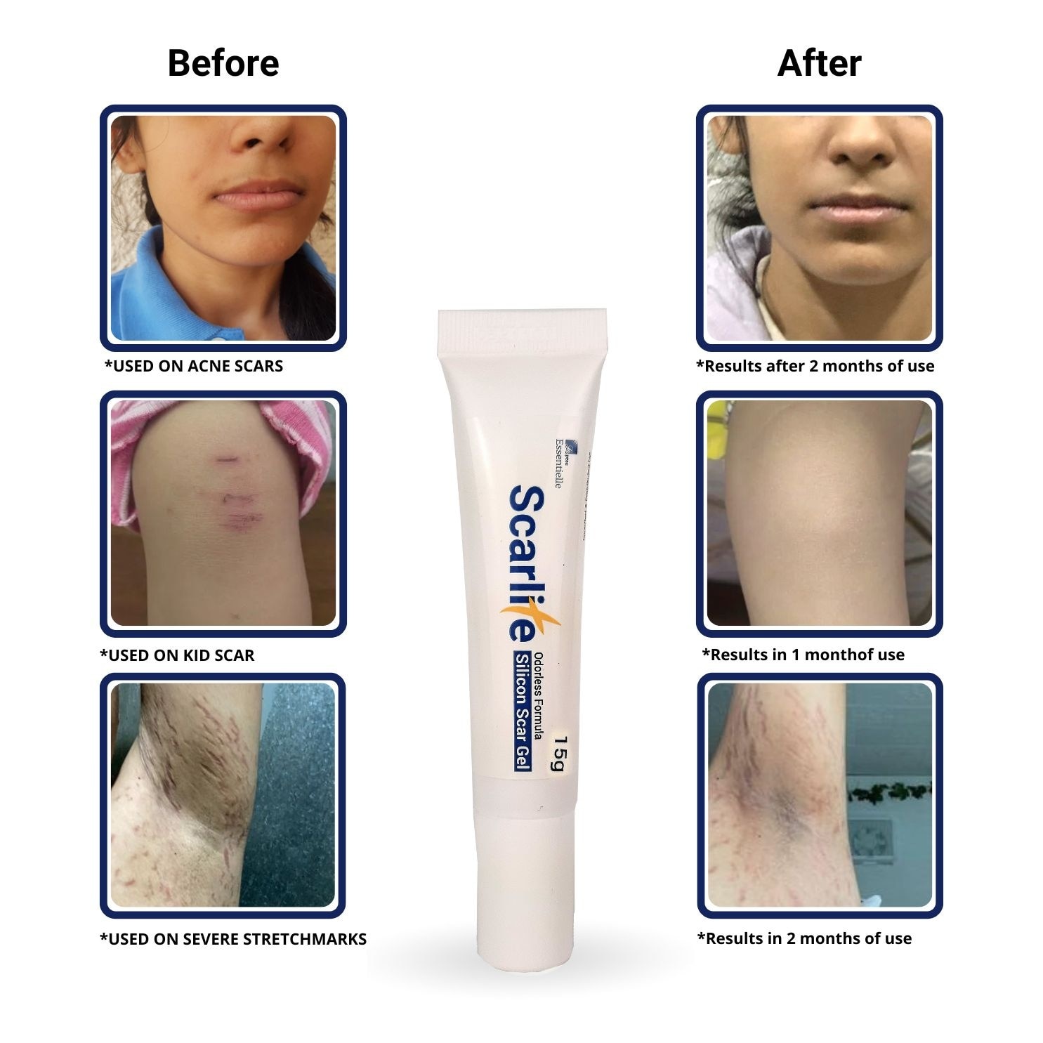 SCARLITE Silicon scar gel 15 grams