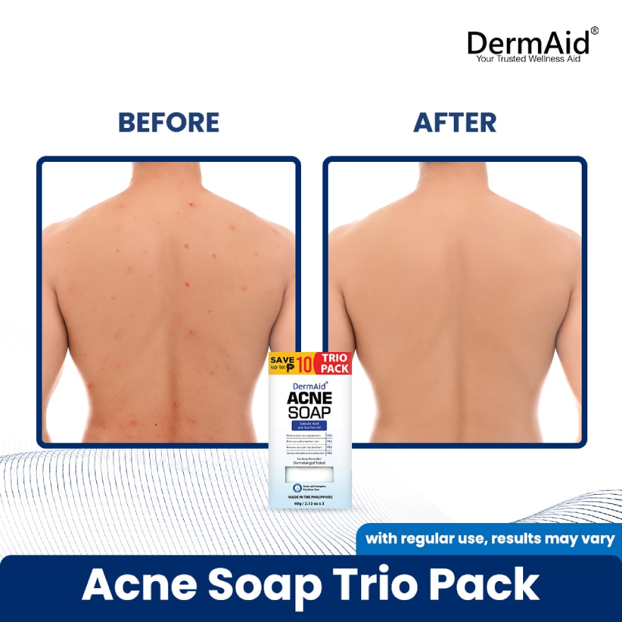 DERMAID Acne Soap Trio Pack 60g 3s