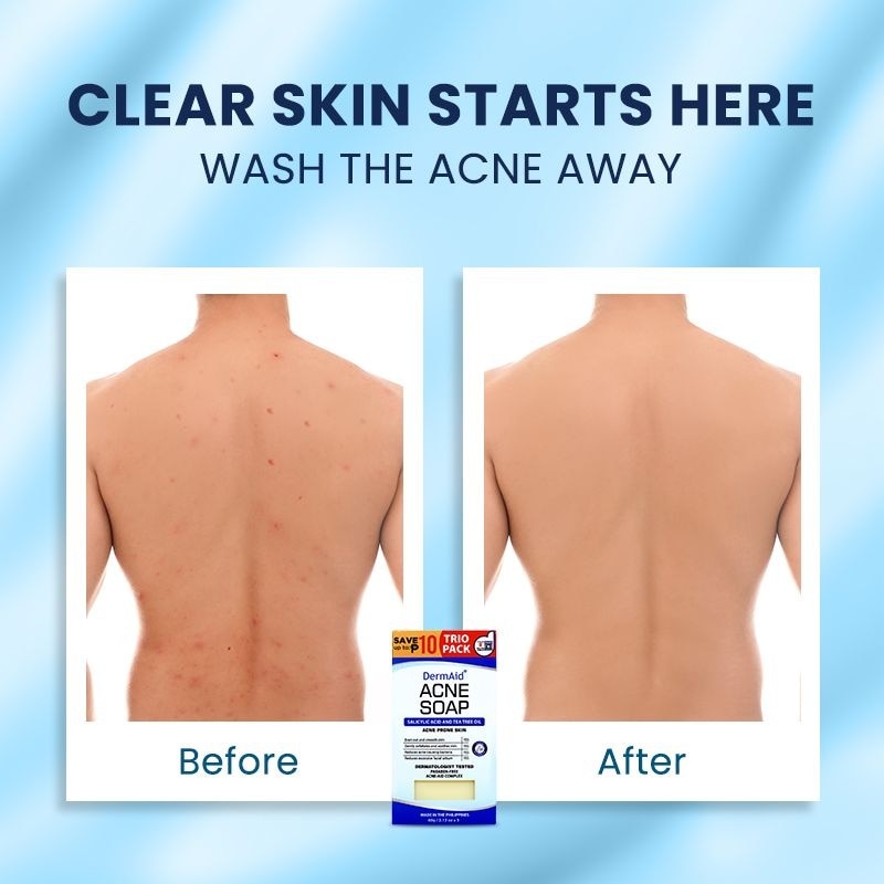 DERMAID Acne Soap Trio Pack 60g 3s