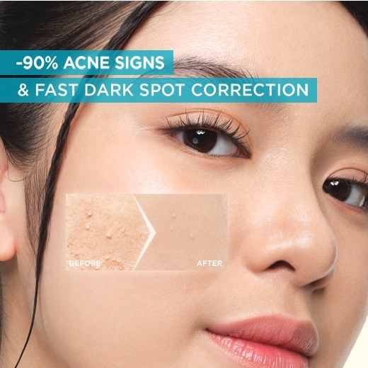 Bright Complete Anti Acne Serum (7.5ml) with Niacinamide