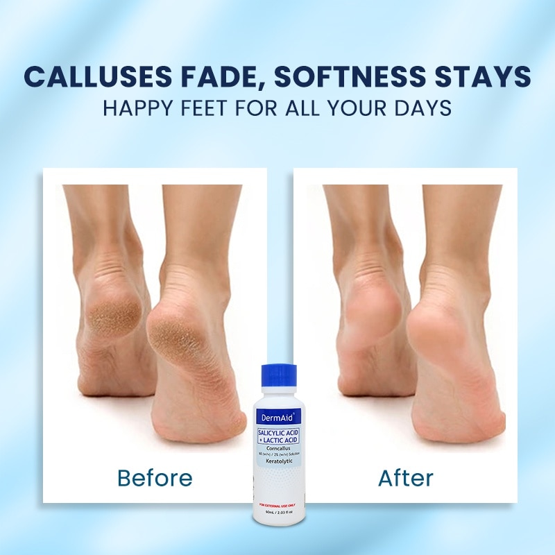 Corn and Callous Remover 60ml