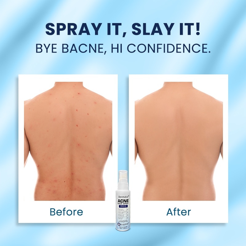 Acne Back Spray 50ml