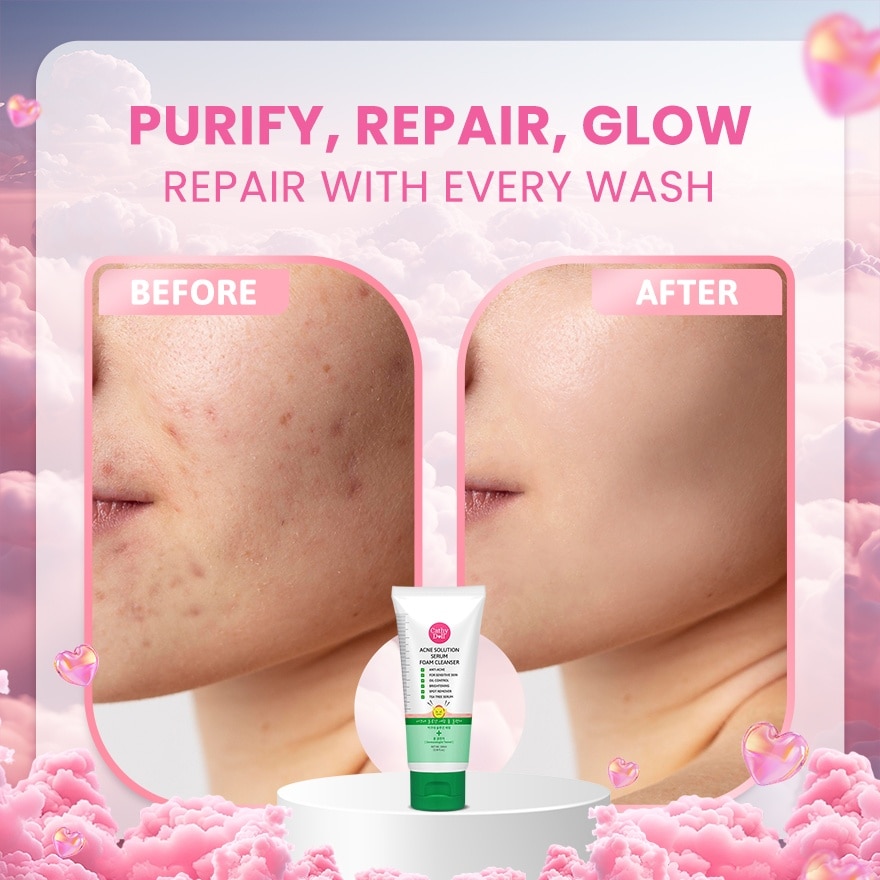 Acne Solution Serum Foam Cleanser 100ml