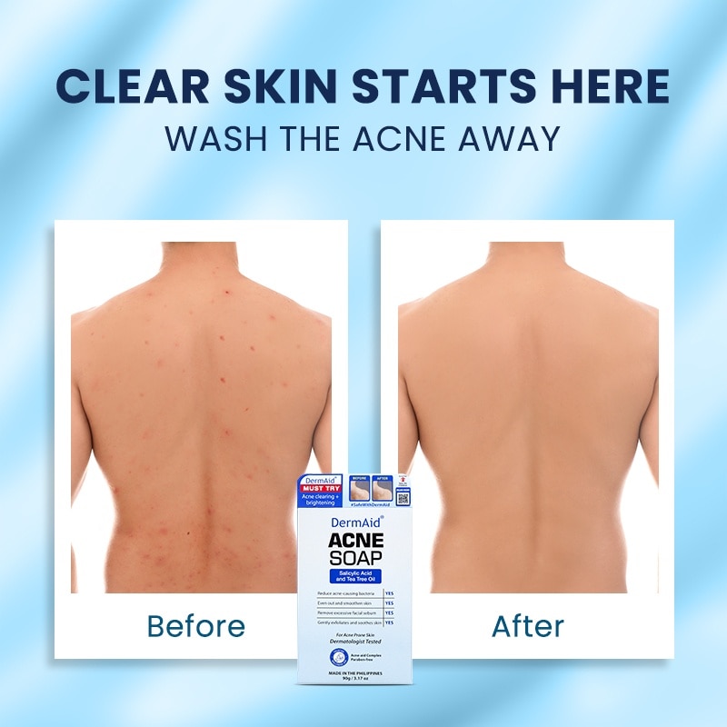 Acne Soap Facial Cleansing Bar 90g