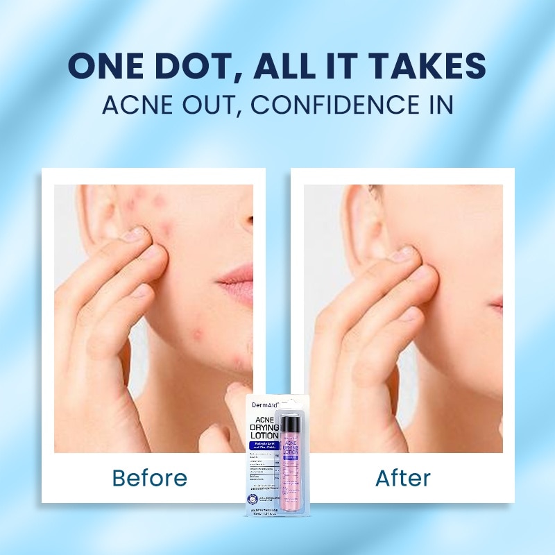 DERMAID Acne Drying Lotion 25ml