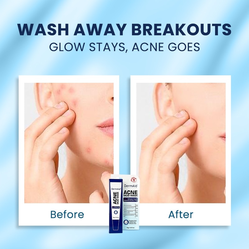 DERMAID Acne Mud Mask 10g