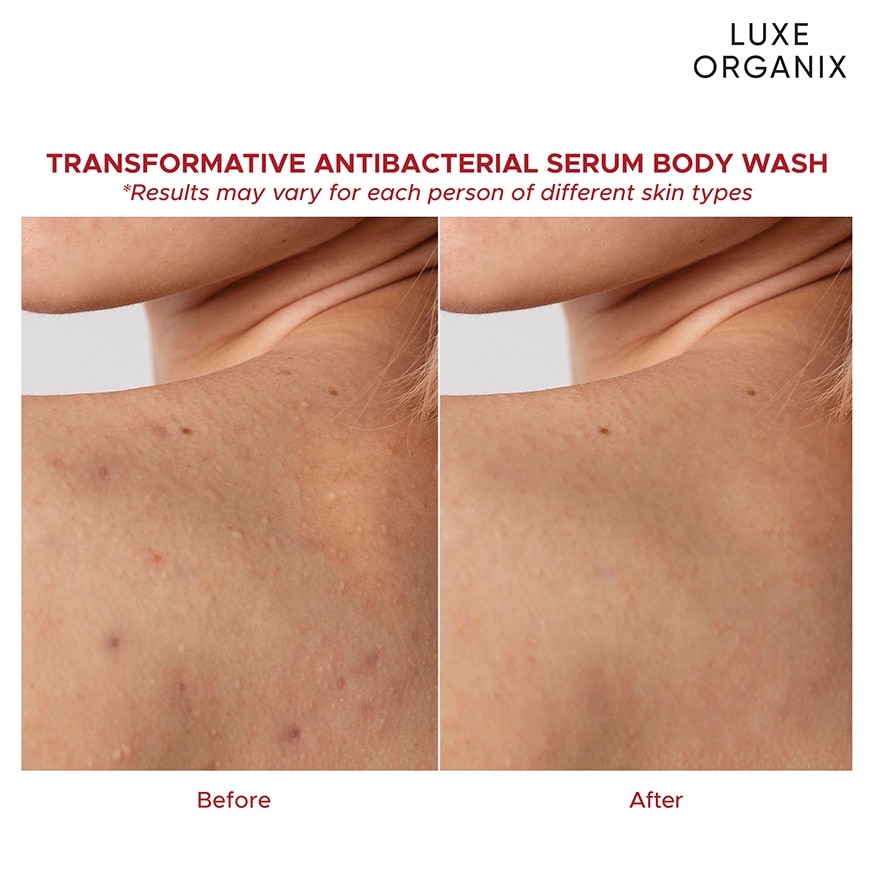 Luxe Organix Dermapro Salicylic Acid 2% Acne Rescue Serum Antibacterial Body Wash 500Ml