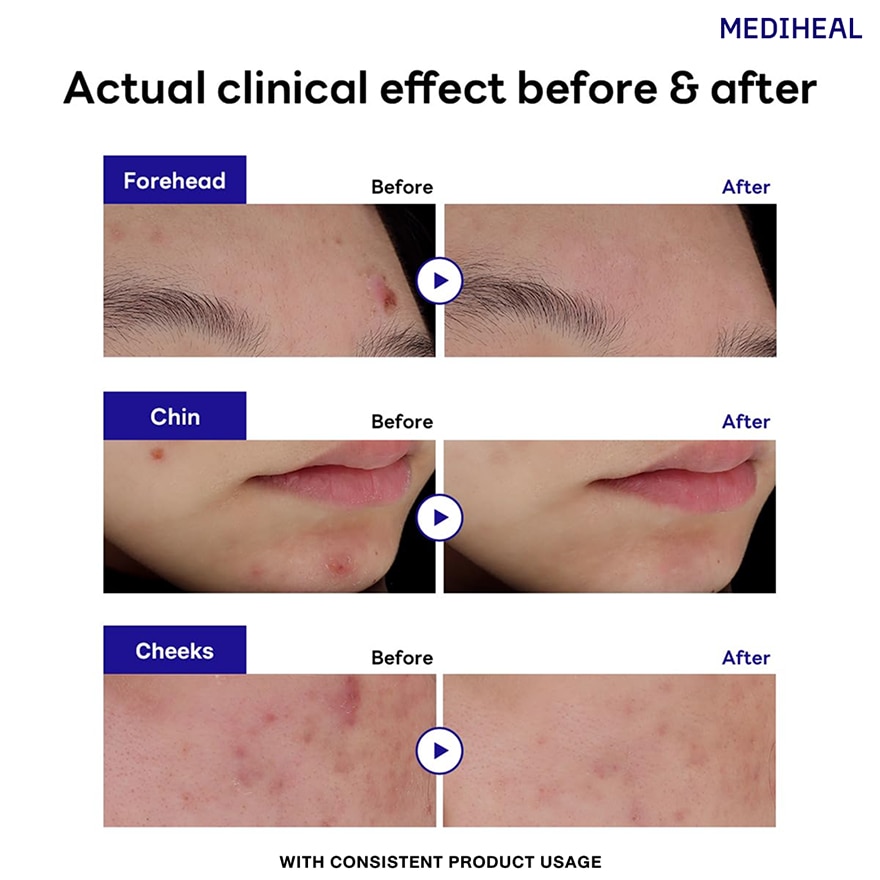 MEDIHEAL Derma Clear Teartree Trouble Spot Patch 25