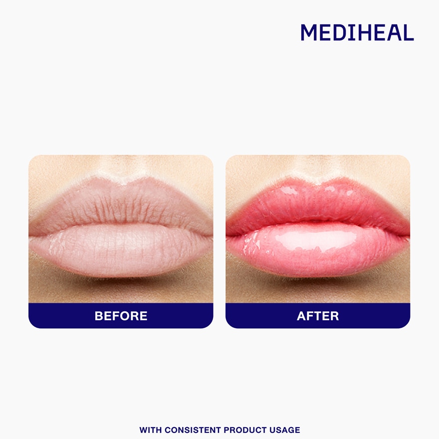 MEDIHEAL Panteno Lips Healssence Coral