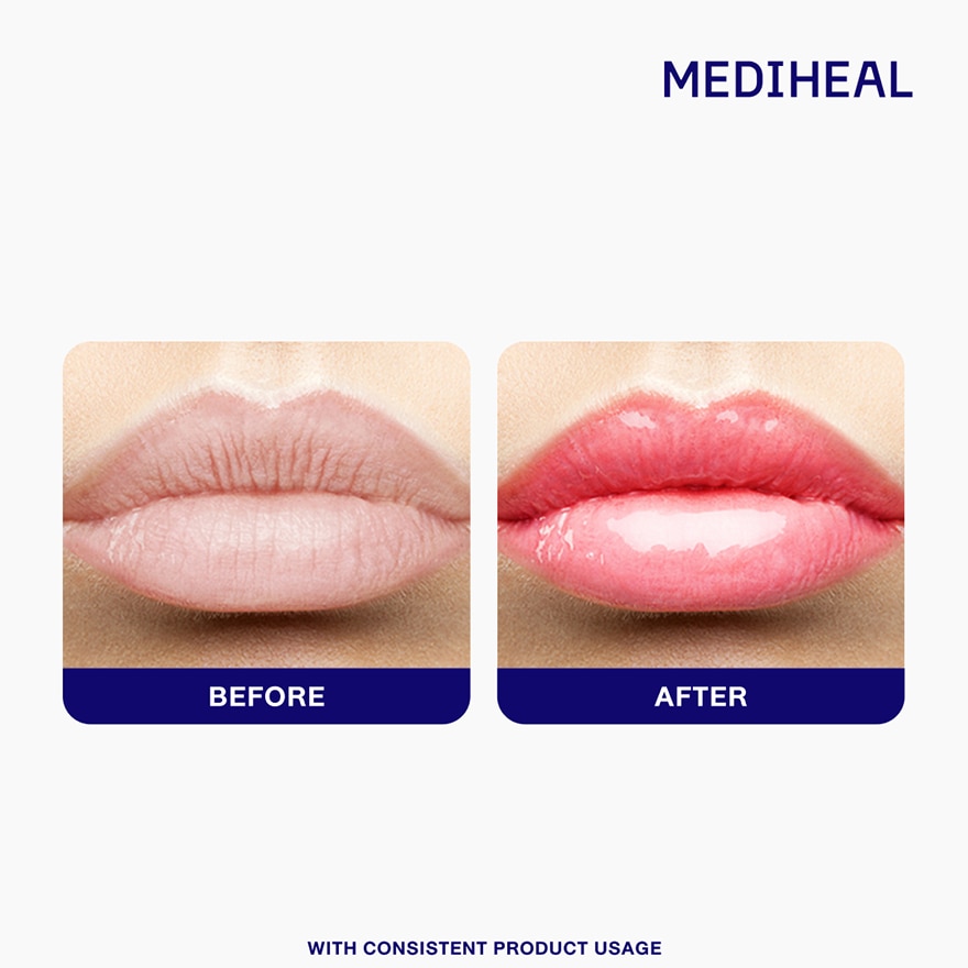 MEDIHEAL Panteno Lips Healssence