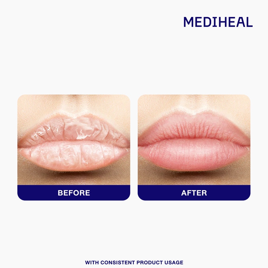 MEDIHEAL Panteno Lips Healbalm