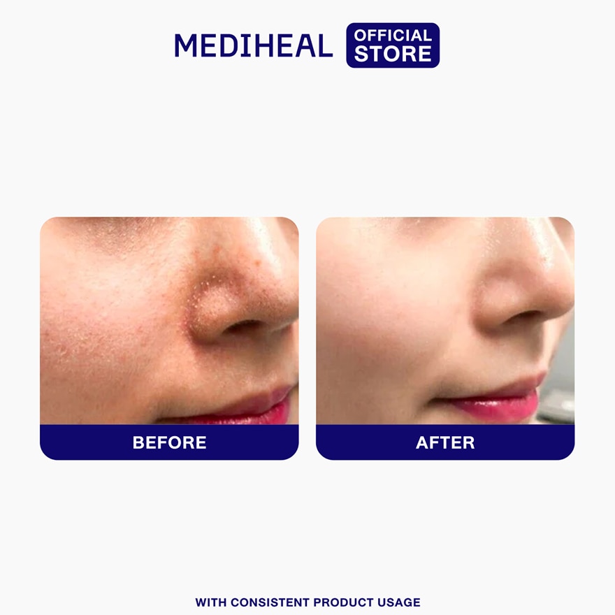 MEDIHEAL Madecassoside Blemish Pad