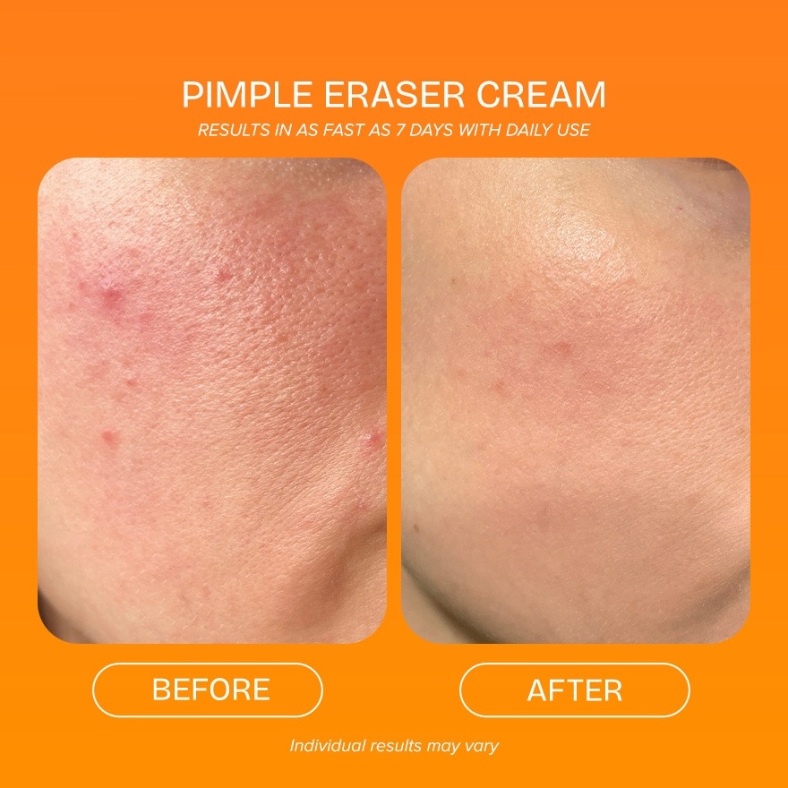 Pimple Eraser 30g