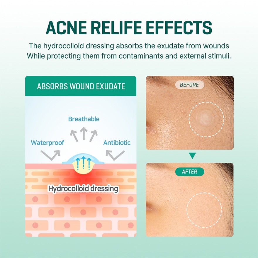 SOME BY MI Clear Spot Patch 18 Patches