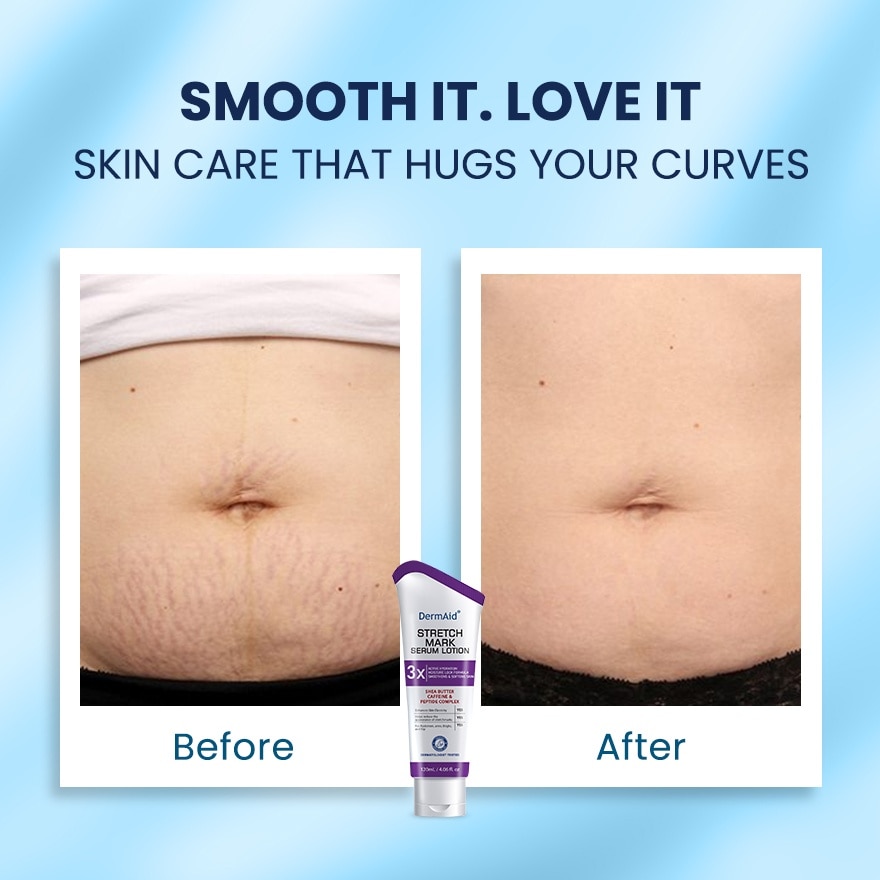 DERMAID Stretchmark Serum Lotion 120ml